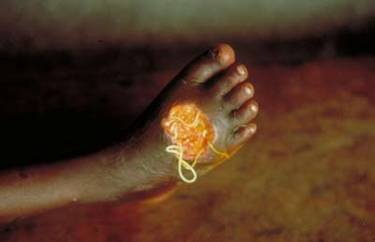 Biblical proporsions suffering in Yemen continues: New decease discovered – Ancient rare parasite Guinea worm  –